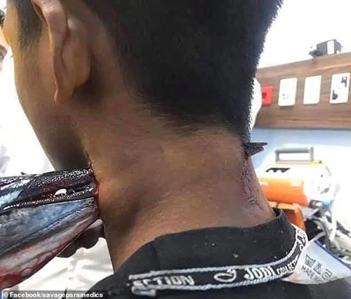Hình ảnh nạn nhân bị mũi cá nhói găm xuyên qua cổ. Ảnh: Daily Mail
