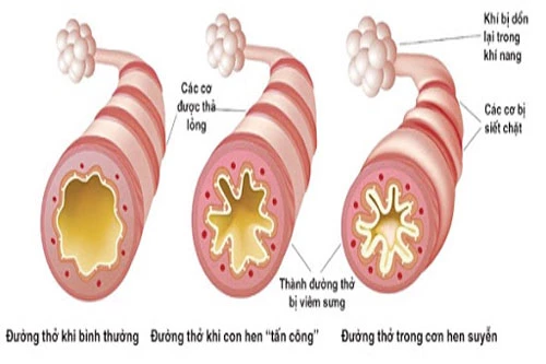 Co thắt phế quản gây nên cơn hen