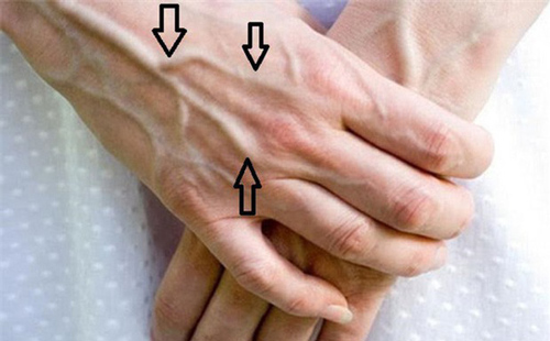 Dấu hiệu trên bàn tay cảnh báo gan đang nhiễm độc, "nhàu nát" từng ngày, nguy hại nhất là số 1