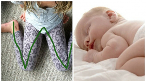 Sai lầm thường gặp của mẹ khiến trẻ chân vòng kiềng, dành 1 phút đọc để bé có một đôi chân như người mẫu