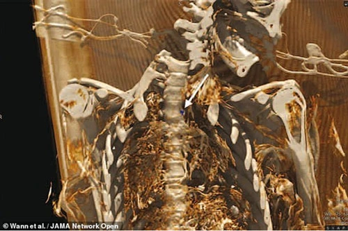 Trong ảnh, một bản dựng lại 3D trong vùng bụng của một xác ướp. Mũi tên chỉ ra một mảng xơ vữa động mạch vôi hóa. (Nguồn: Wann et al)