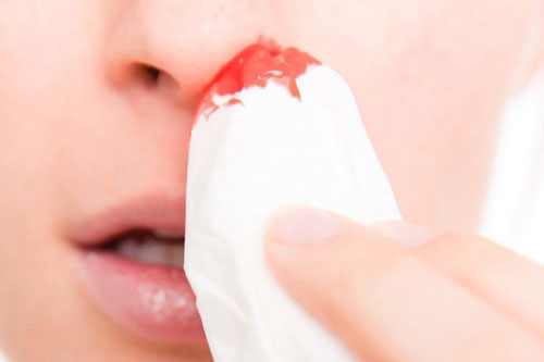Nước mũi có máu, nguyên nhân do đâu?