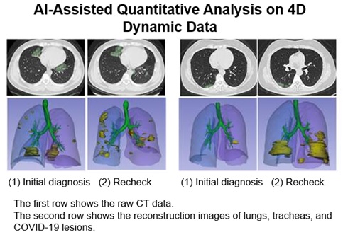 HUAWEI CLOUD hỗ trợ chống COVID-19 tại Hồ Bắc: Cho ra các kết quả định lượng CT trong vài giây