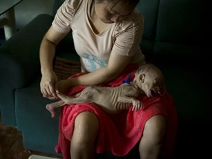 Bé gái mắc bệnh lạ trông như người ngoài hành tinh