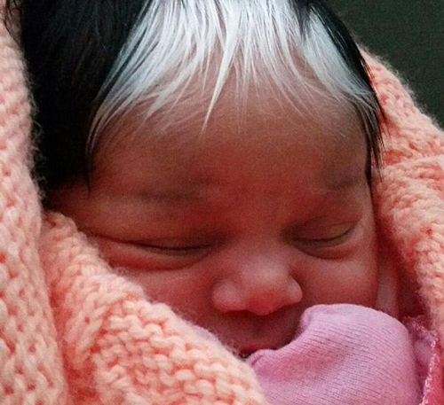 Kỳ lạ: Em bé sinh ra có 2 màu tóc, 2 màu da và vết bớt trắng đặc biệt