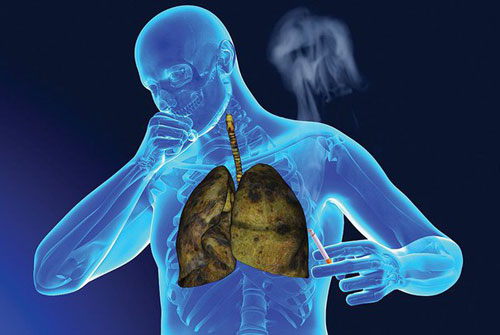 Nếu bàn tay có dấu hiệu này hãy đi khám ngay kẻo ung thư phổi sắp 'ghé thăm' bạn