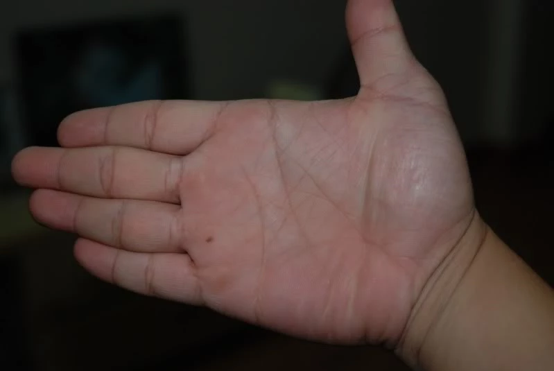 Xem bói ý nghĩa nốt ruồi nằm trong lòng bàn tay (Ảnh: Internet)
