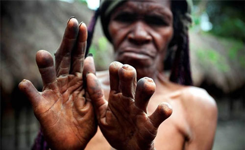 Một người bị chặt nhiều ngòn tay vì người thân qua đời của bộ tộc Dani