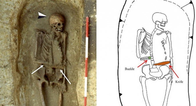 Sự thật đáng sợ về bộ hài cốt người đàn ông lắp dao thay bàn tay
