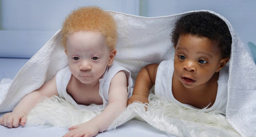 Xuất hiện cặp song sinh chào đời cách nhau vài phút nhưng lại có màu da đặc biệt khiến bác sĩ cũng "tròn mắt"