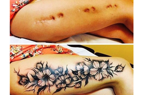 Không may để lại sẹo xấu xí trên cơ thể, hãy "thủ tiêu" chúng bằng cách làm "cực độc"này