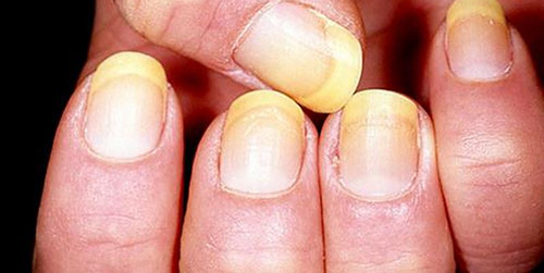 Đặc biệt chú ý nếu móng tay xuất hiện điều này, dấu hiệu cảnh báo cơ thể đang mắc một số bệnh nguy hiểm