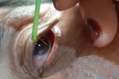 'Rùng mình' khi nhìn thấy ký sinh trùng di chuyển trên mặt người phụ nữ