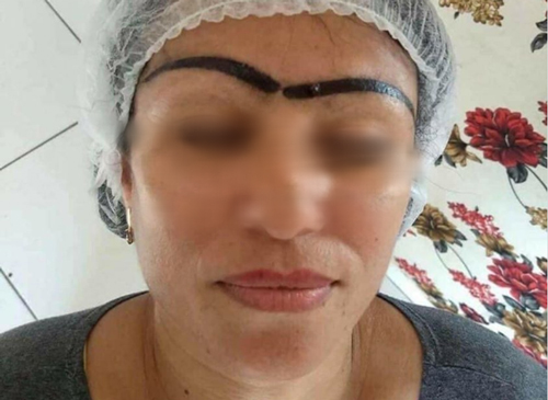 Một phen "dở khóc dở cười" với "thảm họa" xăm lông mày bị hỏng của người phụ nữ trung niên