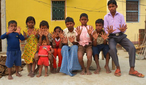 Chuyện lạ: Gia đình 25 người ai cũng đều có 12 ngón tay, 12 ngón chân