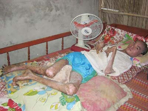 Giải mã bí ẩn về "người rắn" bị rắn hổ chúa "báo oán"