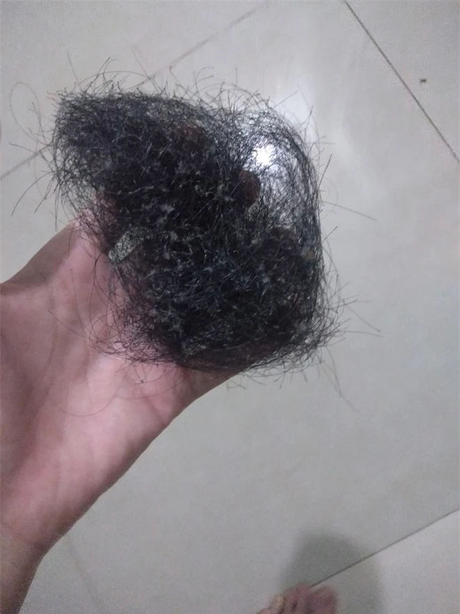 Cô gái hễ bị stress là nhổ tóc, nhìn tình cảnh bây giờ, ai cũng phải sợ hãi khuyên can hết lời - Ảnh 3. Cô gái hễ bị stress là nhổ tóc, nhìn tình cảnh bây giờ, ai cũng phải sợ hãi khuyên can hết lời - Ảnh 3.