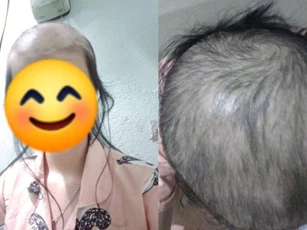 Cô gái hễ bị stress là nhổ tóc, nhìn tình cảnh bây giờ, ai cũng phải sợ hãi khuyên can hết lời