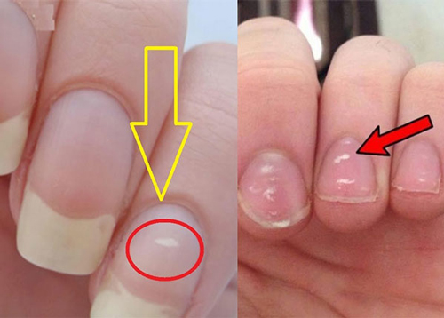 Đốm trắng trên móng tay "tố" căn bệnh nguy hiểm, nhiều người vẫn vô tư bỏ qua