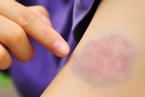 Những cách làm tan máu bầm nhanh chóng và hiệu quả ngay tại nhà