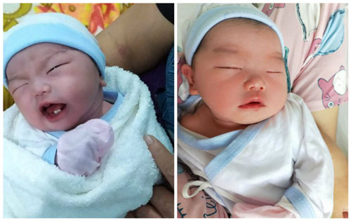 Bé sơ sinh chào đời đã có 2 răng cửa khiến các bác sĩ vô cùng bất ngờ