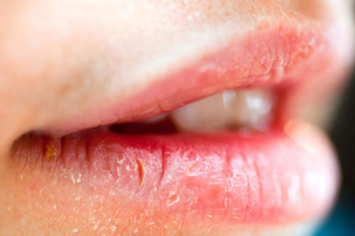 8 tuyệt chiêu đơn giản trị khô môi siêu hiệu quả có thể làm tại nhà