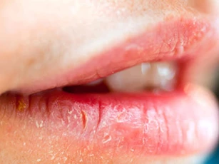 8 tuyệt chiêu đơn giản trị khô môi siêu hiệu quả có thể làm tại nhà