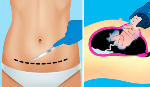 Mách mẹ 5 cách giúp vết mổ đẻ không đau, nhanh lành, không để lại sẹo