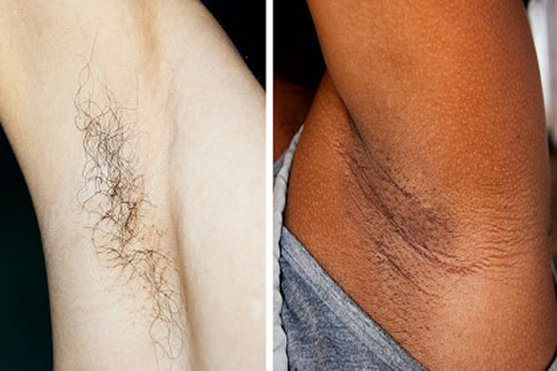 Tại sao ngày càng nhiều phụ nữ ngừng việc cạo lông trên cơ thể?