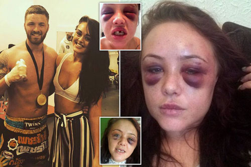 Đòi chia tay vì phát hiện quá khứ chuyên "thượng cẳng chân hạ cẳng tay" của bạn trai võ sư, cô gái bị đánh đập đến mức "sang chấn tâm lý"