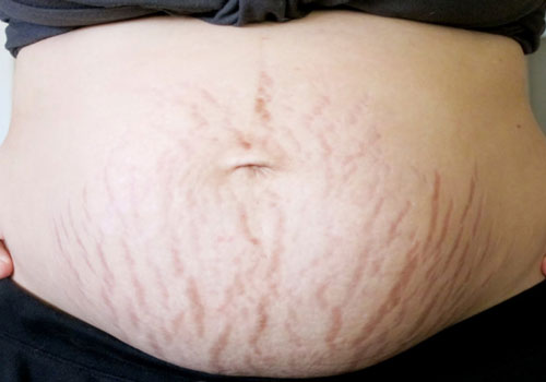 Rạn da lúc mang thai: Mẹ bầu chỉ cần làm mấy việc dễ ợt này là da có thể đẹp như thời con gái