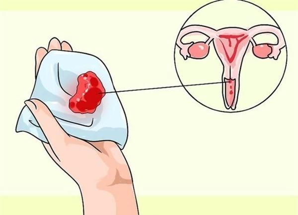 3 dấu hiệu trong ngày đèn đỏ” cảnh báo bệnh ung thư cổ tử cung đang ngầm phát triển, mọi phụ nữ đều nên biết để phòng tránh-2