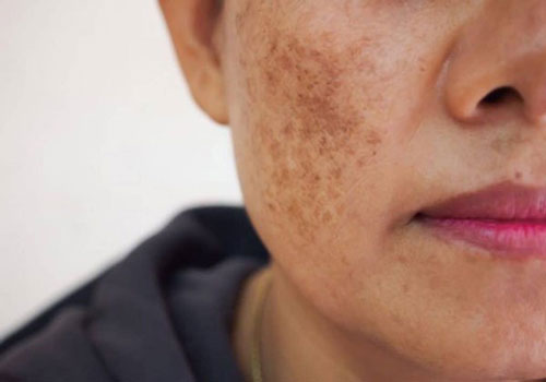 'Sống chung' với nám bao năm là vì bạn chưa biết đến 5 loại mặt nạ trị nám này thôi!