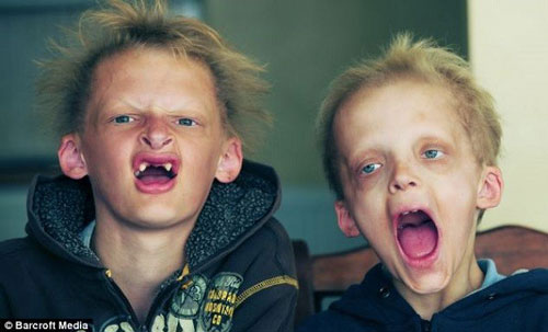 Hãi hùng những căn bệnh khó hiểu biến con người thành “quái vật”