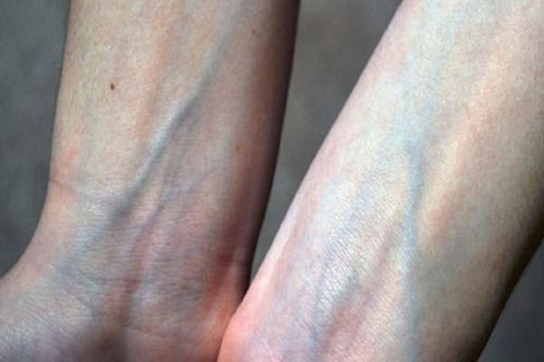 Đi viện gấp khi thấy các bộ phận này trên cơ thể nổi gân xanh, kẻo tới lúc hối hận thì quá muộn