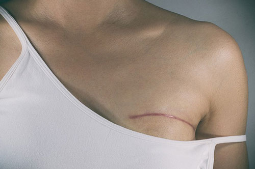 Bác sĩ cảnh báo: Có dấu hiệu này là nguy cơ ung thư vú, chị em nào cũng cần cảnh giác