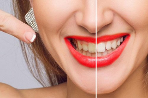 5 loại đồ uống quen thuộc khiến răng xỉn màu, ngả vàng xấu xí