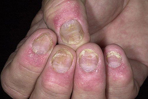 3 bài thuốc dân gian chữa nấm móng hiệu quả: Vừa đơn giản lại còn tiết kiệm được đống tiền