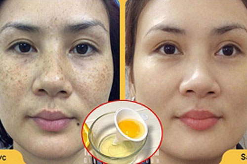 "Đánh bay" vết nám da cứng đầu lâu năm với nguyên liệu cực rẻ mà lại dễ tìm