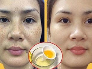 "Đánh bay" vết nám da cứng đầu lâu năm với nguyên liệu cực rẻ mà lại dễ tìm