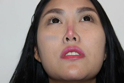 Những mỹ nhân Việt gặp biến chứng vì thẩm mỹ hỏng