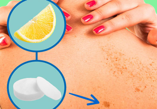 Bài thuốc tại nhà: Cách trị đốm đen trên da hiệu quả