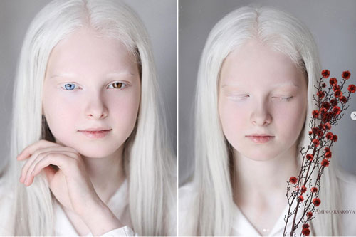 Bé gái nổi tiếng nhờ đôi mắt hai màu