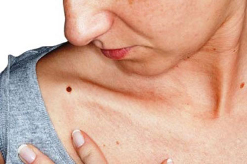 Những nốt ruồi son mang lại may mắn, tài lộc cấm không được tẩy xóa