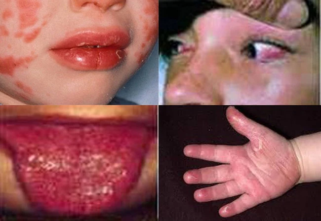 Một số biểu hiện của bệnh Kawasaki. (Ảnh: TTXVN)