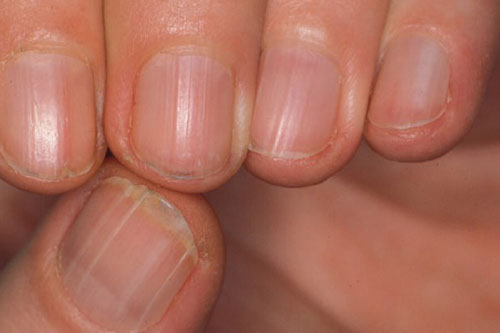Móng tay có những dấu hiệu này báo hiệu nội tạng mắc bệnh nguy hiểm