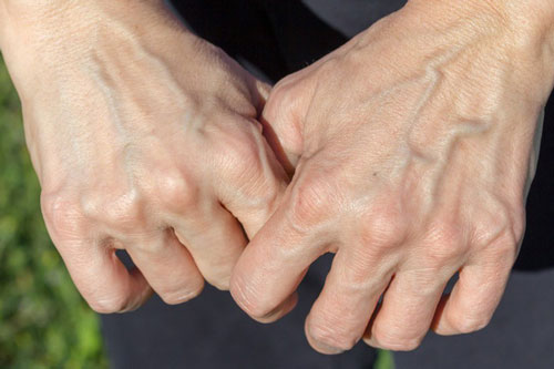 Nếu gân xanh bất ngờ nổi lên ở những điểm này thì hãy đi khám ngay kẻo hối không kịp