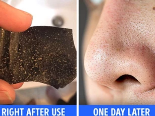 6 điều nên biết trước khi lột mụn đầu đen