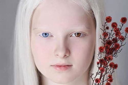 Vẻ đẹp khác thường của một cô bé mang bệnh bạch tạng, mắt hai màu khiến dân mạng phải xuýt xoa