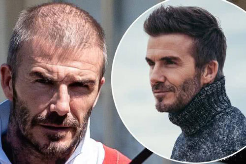 David Beckham đối mặt với chứng rụng tóc và tuổi tác